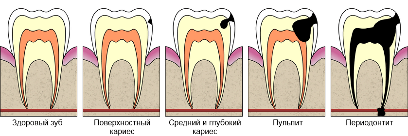 Этапы развития заболеваний зубов