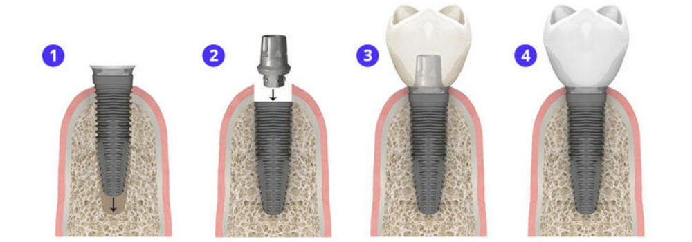 Одноэтапная имплантация при восстановлении отдельных зубов