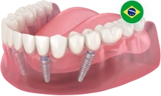 All-on-4 (Все-на-4) Neodent