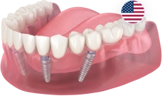 All-on-4 (Все-на-4) Nobel Biocare