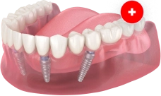 All-on-4 (Все-на-4) Straumann