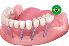 All-on-6 (Все-на-6) Neodent