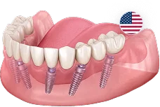 All-on-6 (Все-на-6) Nobel