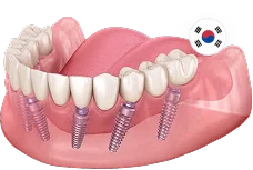 All-on-6 (Все-на-6) Osstem