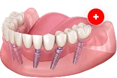 All-on-6 (Все-на-6) Straumann