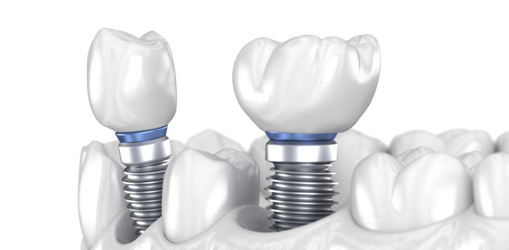 otyok-posle-implantacii-zubov