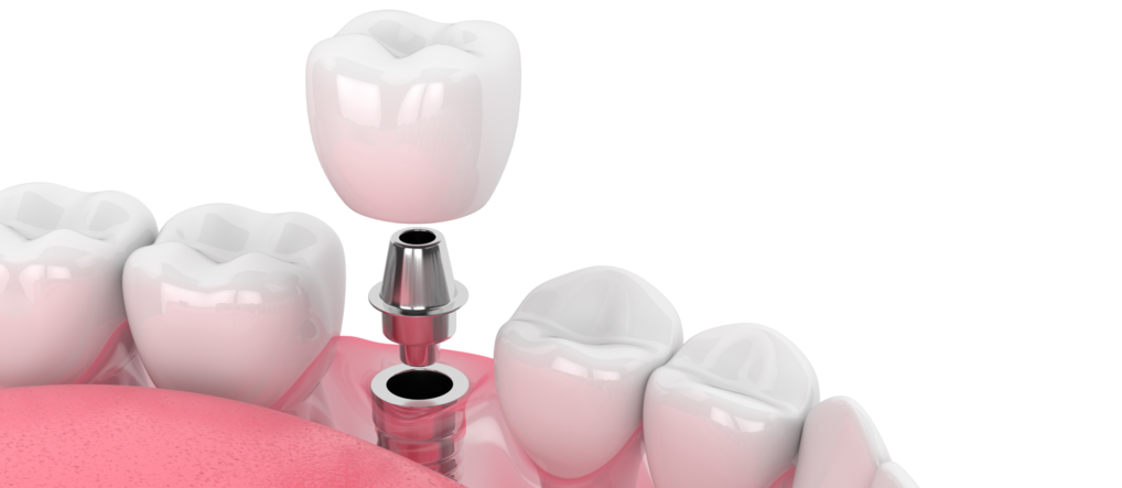 Какой имплант лучше поставить на жевательные зубы