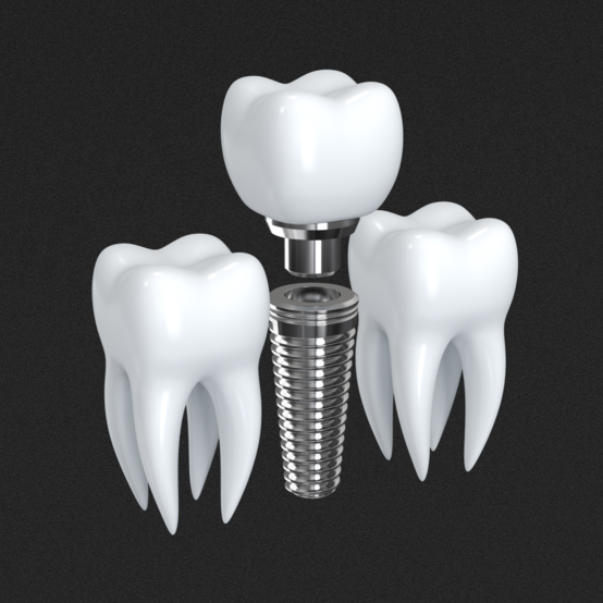 Какой имплант лучше поставить на жевательные зубы