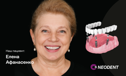 Восстановление всех зубов на 4 имплантах Neodent