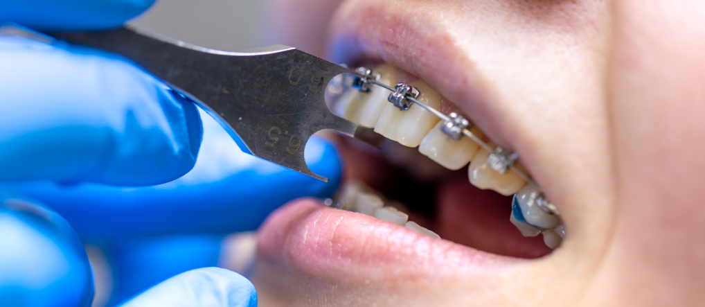 Как привыкнуть к брекетам: сколько длится адаптация