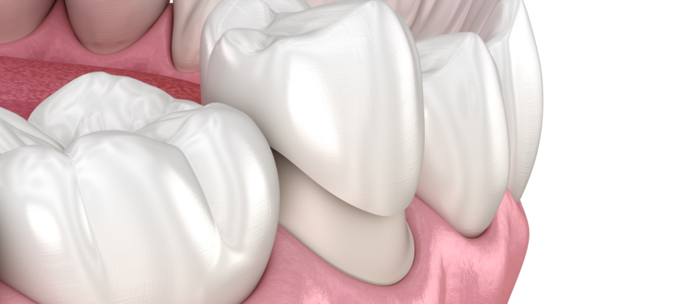 Почему после обточки под коронку болит зуб