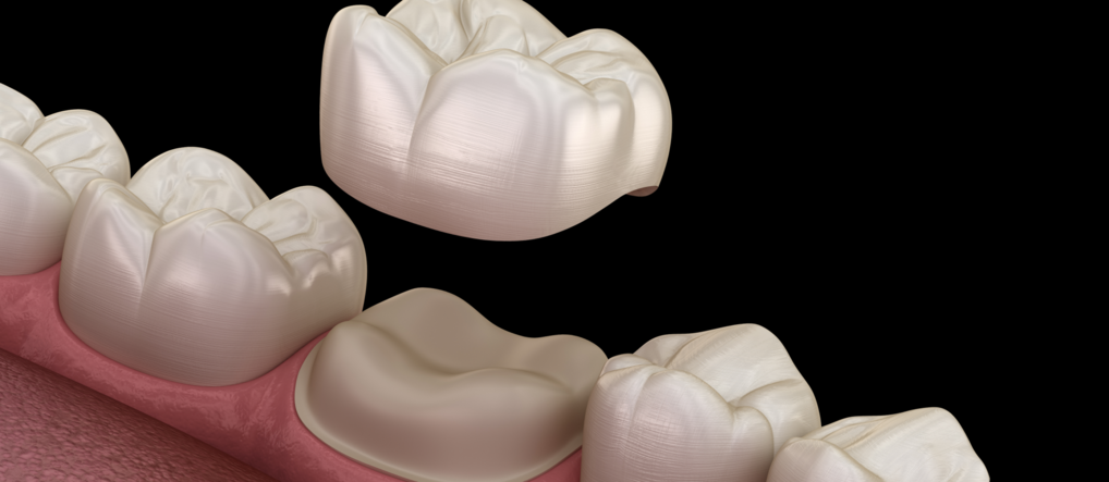 Обточка зуба под коронку: как проходит и нужна ли подготовка