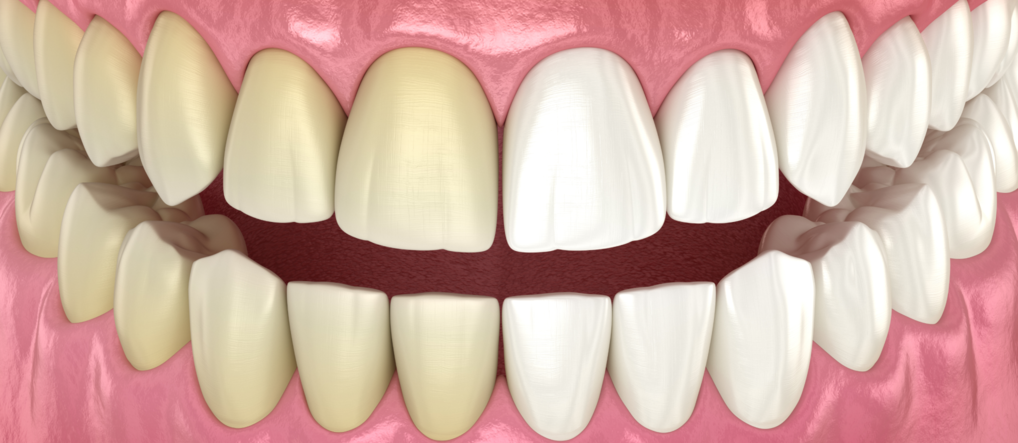 Можно ли отбеливать зубы с пломбами и коронками