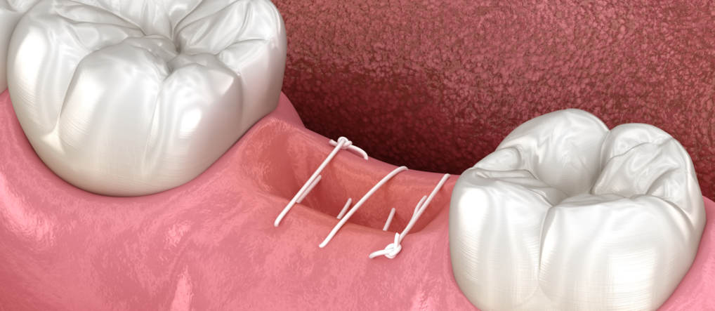 Альвеолит после удаления зуба — как лечить