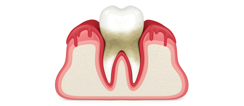 Почему кровоточат дёсны