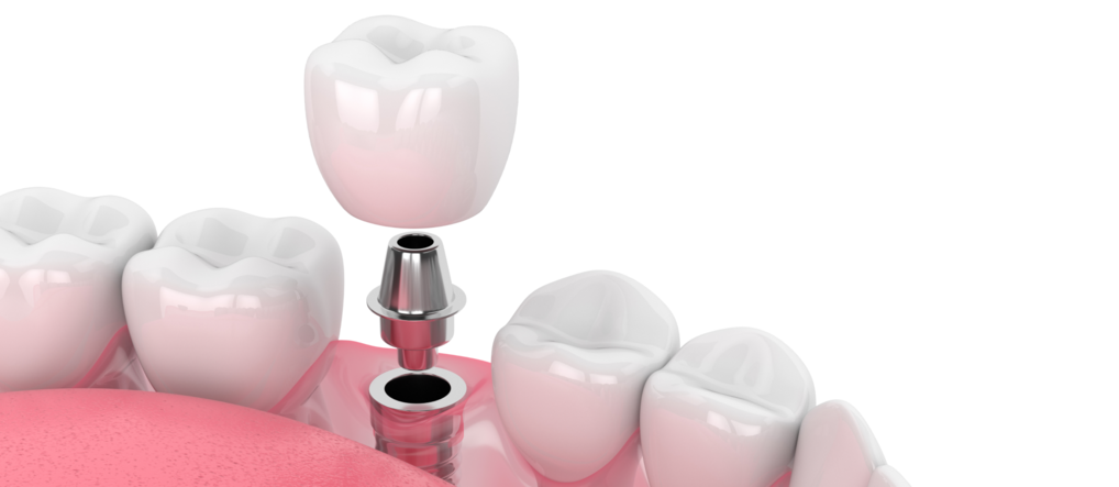 Как проявляется аллергия на импланты зубов