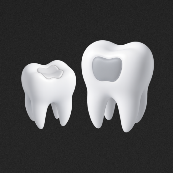 Вкладки или пломбы — что лучше