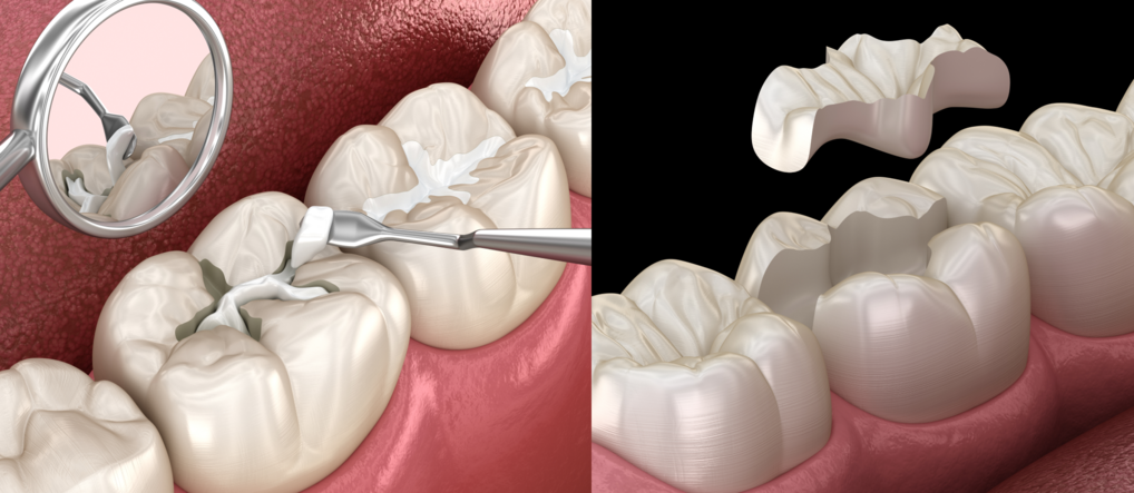 Вкладки или пломбы — что лучше