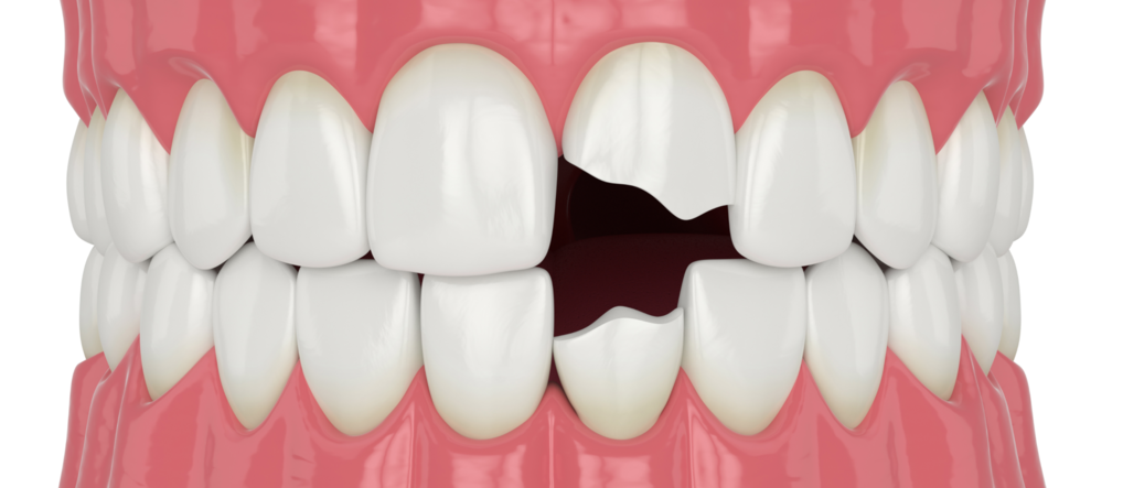 Откололся зуб, что делать