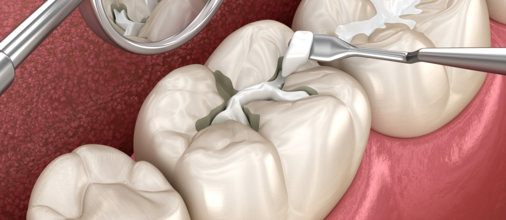 Cколько держится пломба в зубе