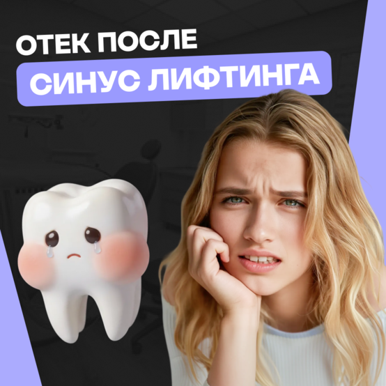 Сколько держится отёк после синус-лифтинга и как его снять