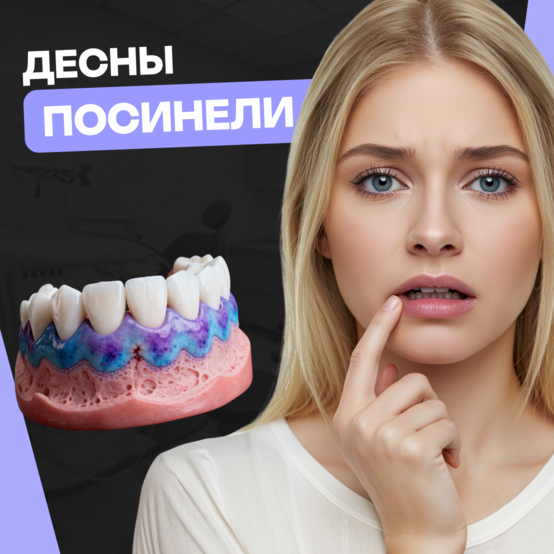 Что делать, если посинели дёсны