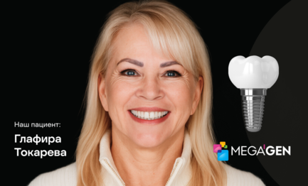 Имплантация Megagen с циркониевой коронкой