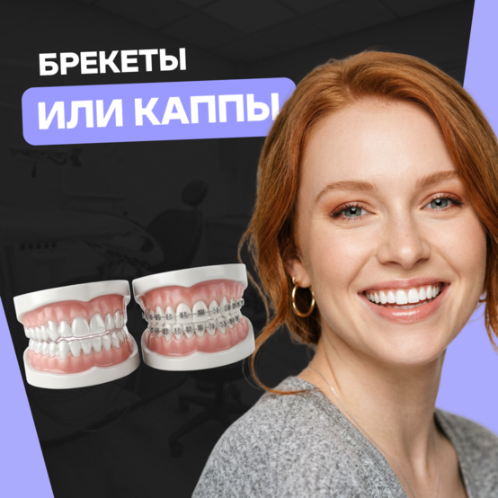Брекеты или каппы: что выбрать для выравнивания зубов