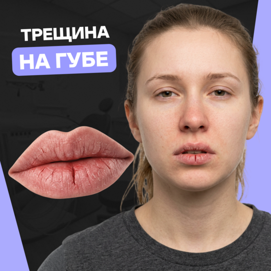 Трещины на губах: причины и лечение