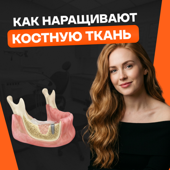 Как наращивают костную ткань для имплантации