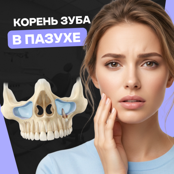 Корень зуба в гайморовой пазухе