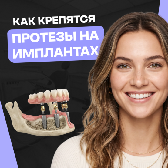 Как крепятся зубные протезы на импланты