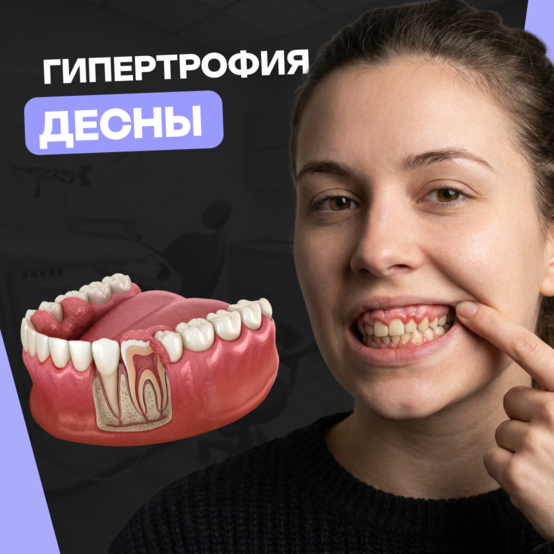 Гипертрофия или разрастание десны