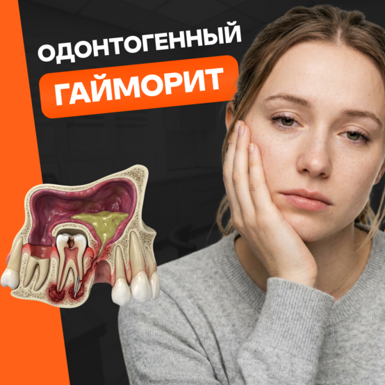 Одонтогенный гайморит: симптомы и лечение