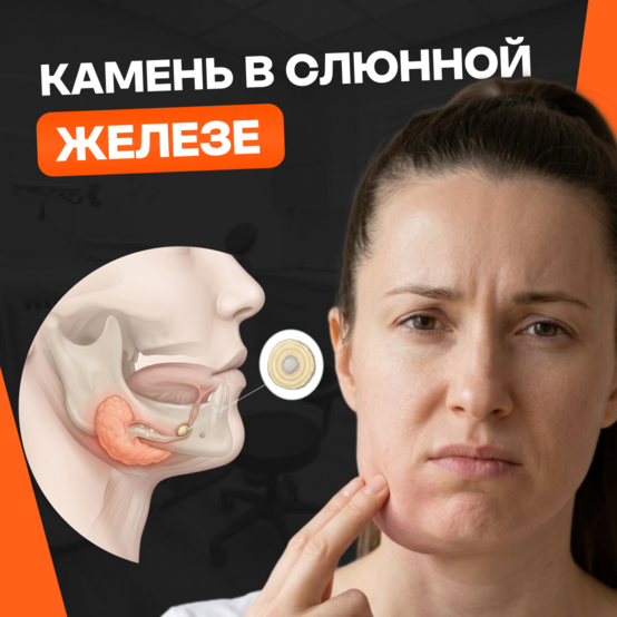 Камень в слюнной железе