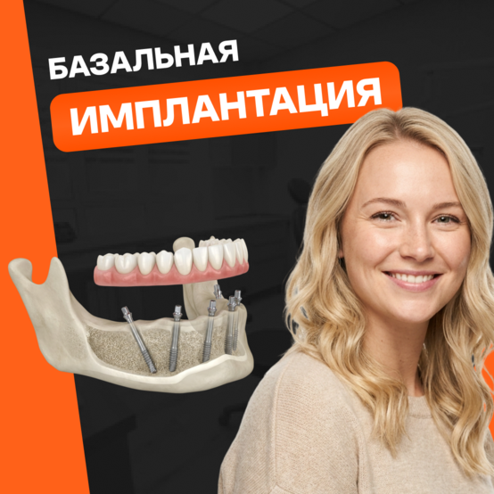 Базальная имплантация: за или против