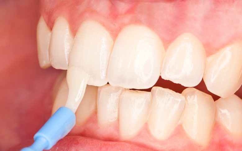 Покрытие зубов фторлаком Томск Правобережная стоматология томск рейтинг