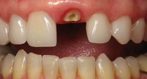 Сильное разрушение зубной коронки