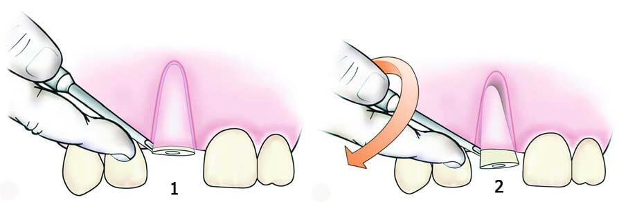 Удаление корня зуба при разрушении коронки