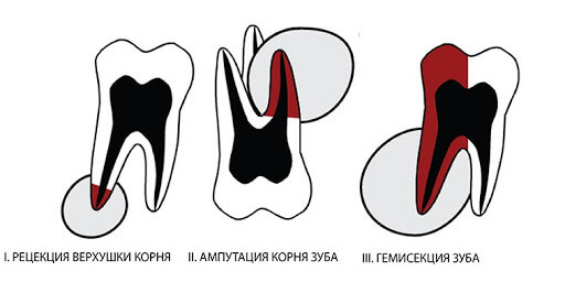 Удаление корня зуба с сохранением коронки