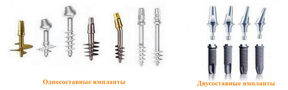 какие импланты лучше ставить дантистофф. Смотреть фото какие импланты лучше ставить дантистофф. Смотреть картинку какие импланты лучше ставить дантистофф. Картинка про какие импланты лучше ставить дантистофф. Фото какие импланты лучше ставить дантистофф