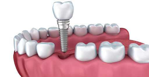 Причины болезненных ощущений после имплантации зубов