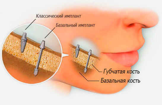 что значит базальная имплантация. Смотреть фото что значит базальная имплантация. Смотреть картинку что значит базальная имплантация. Картинка про что значит базальная имплантация. Фото что значит базальная имплантация