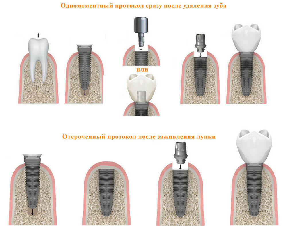 Когда можно поставить имплант после удаления зуба