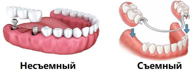 после удаления зуба через какое время можно ставить имплантанты