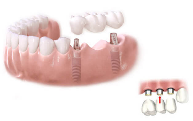 Сколько имплантов нужно при отсутствии 3 зубов