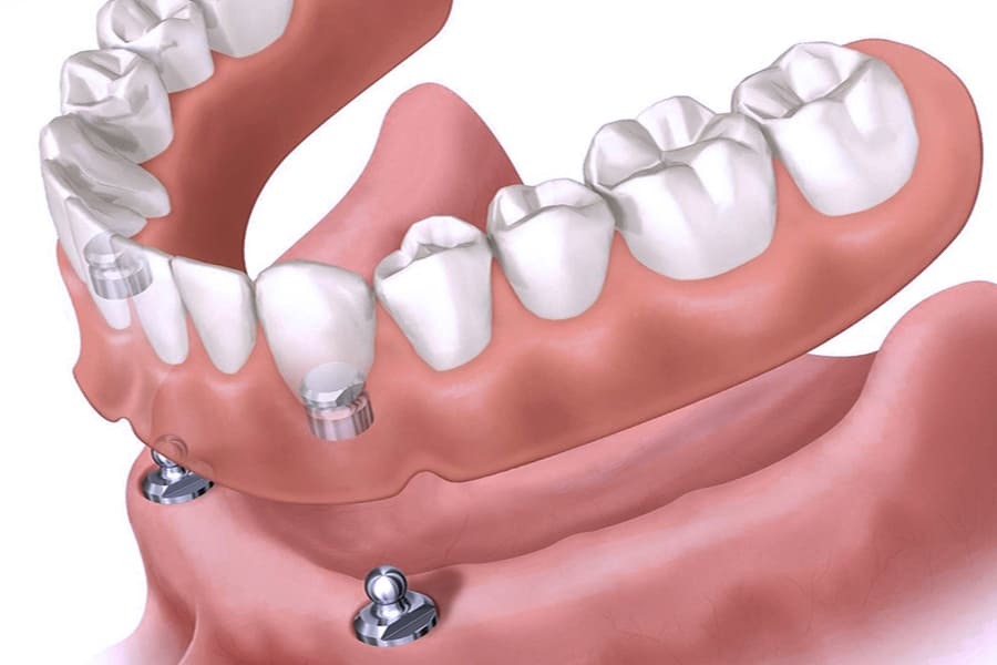 Коррекция зубных протезов - как правильно проводить - Фрезерный CAD/CAM центр Ортос