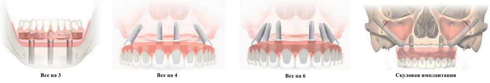 Имплантация всей челюсти без наращивания костной ткани