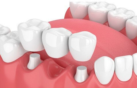 Мостовидный протез на три зуба