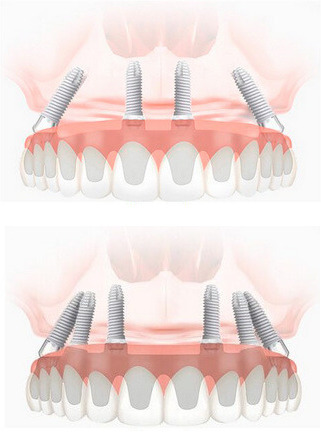 Особенности восстановления челюсти на 4-6 имплантах